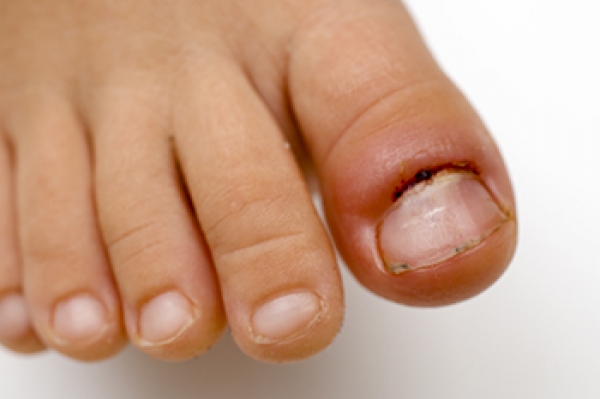 toe-infections